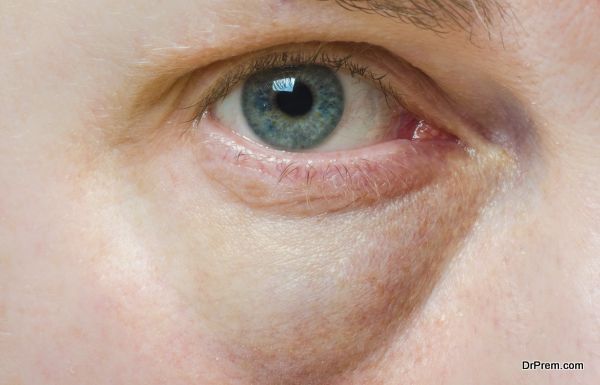 why-you-shouldn-t-ignore-those-early-morning-swollen-eyelids-onlymyhealth