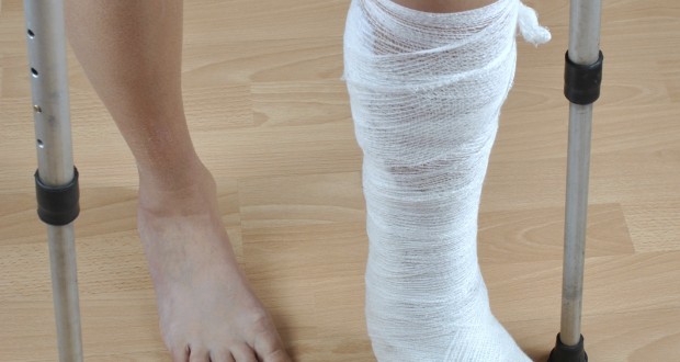 DIY tips to quick healing of a broken bone