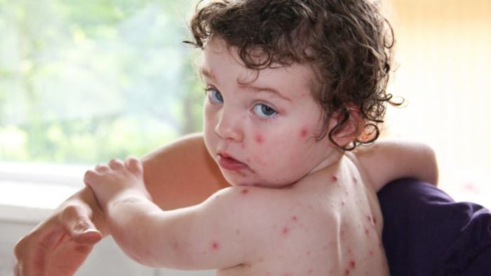 Tips to prevent chicken pox