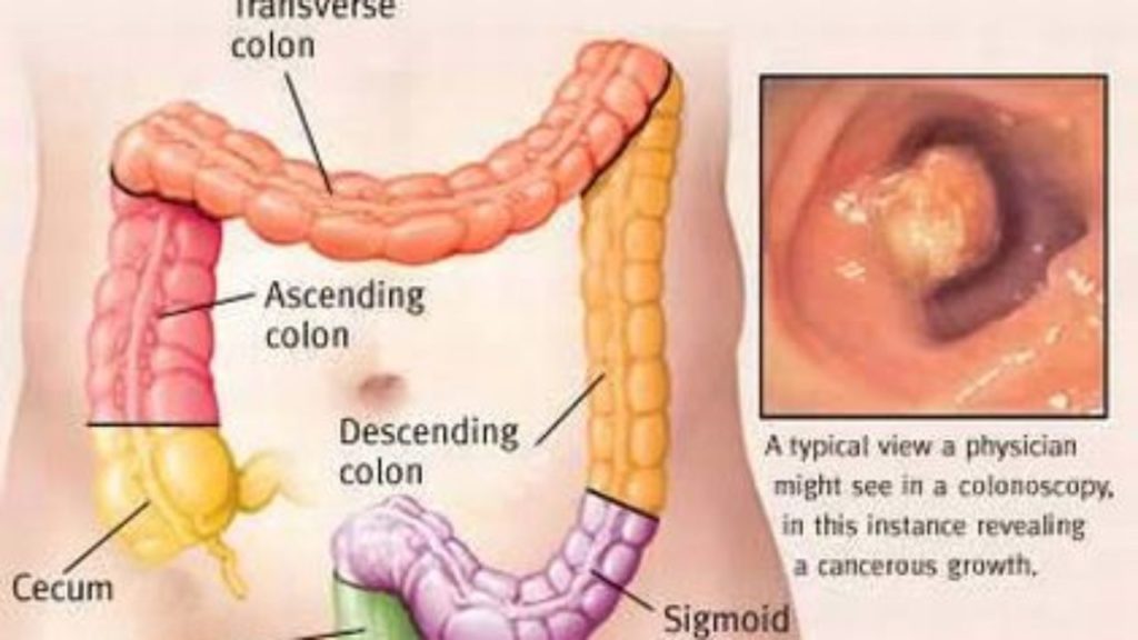 Understanding common signs and symptoms of colon cancer
