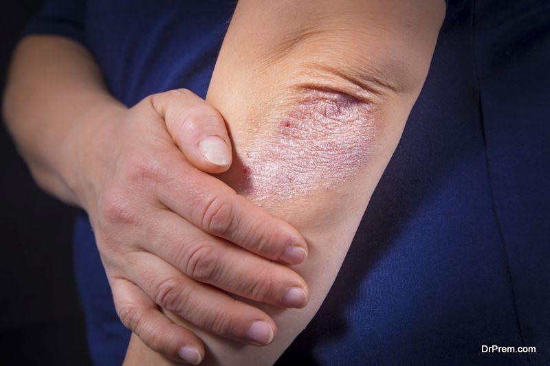 Different types of psoriasis and their proper diagnosis