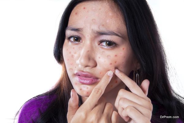 How to treat Acne at home