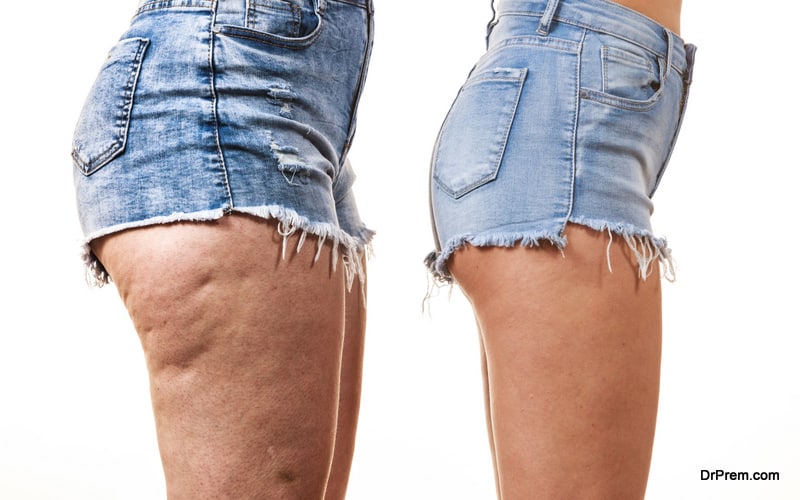 How to fight back cellulite all by yourself
