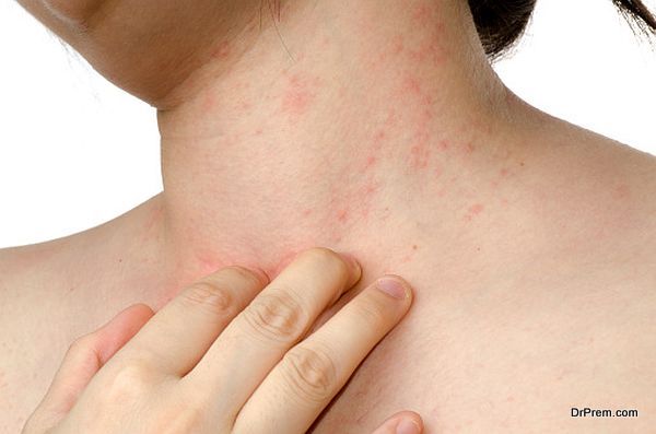 Easy home therapies for Eczema