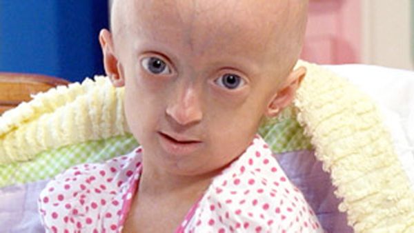 Progeria Exhealth