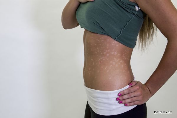 Remedies and good practices for dealing with psoriasis
