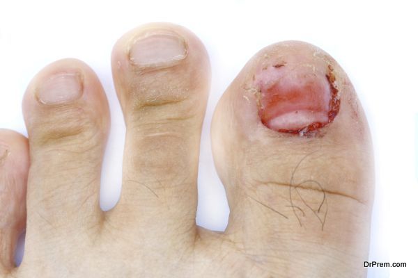 DIY remedies to get rid of toenail fungus
