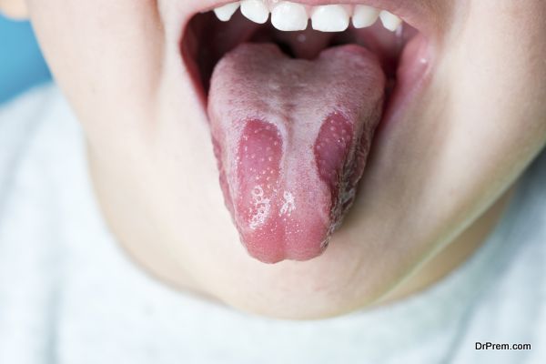 Home remedies for treatment of the burning tongue