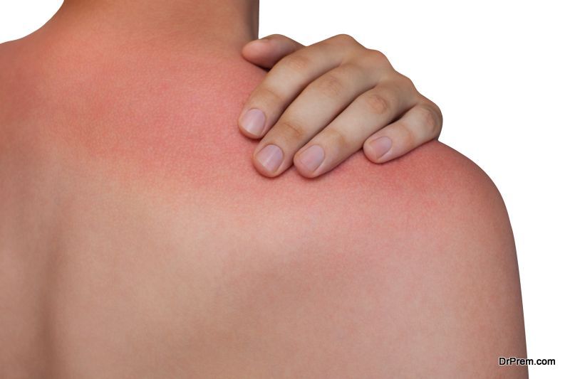 Sunburned-Peeling-Skin