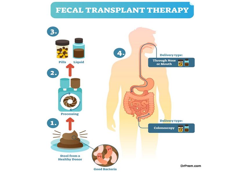 Fecal Transplant