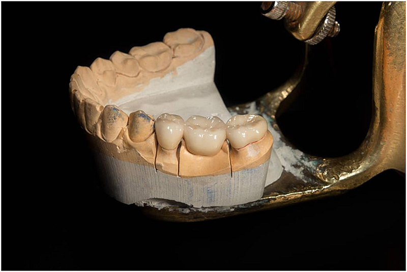 Comprehensive Guide to Dental Crowns and Bridges